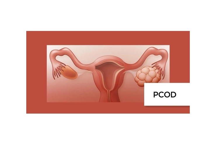 PCOD