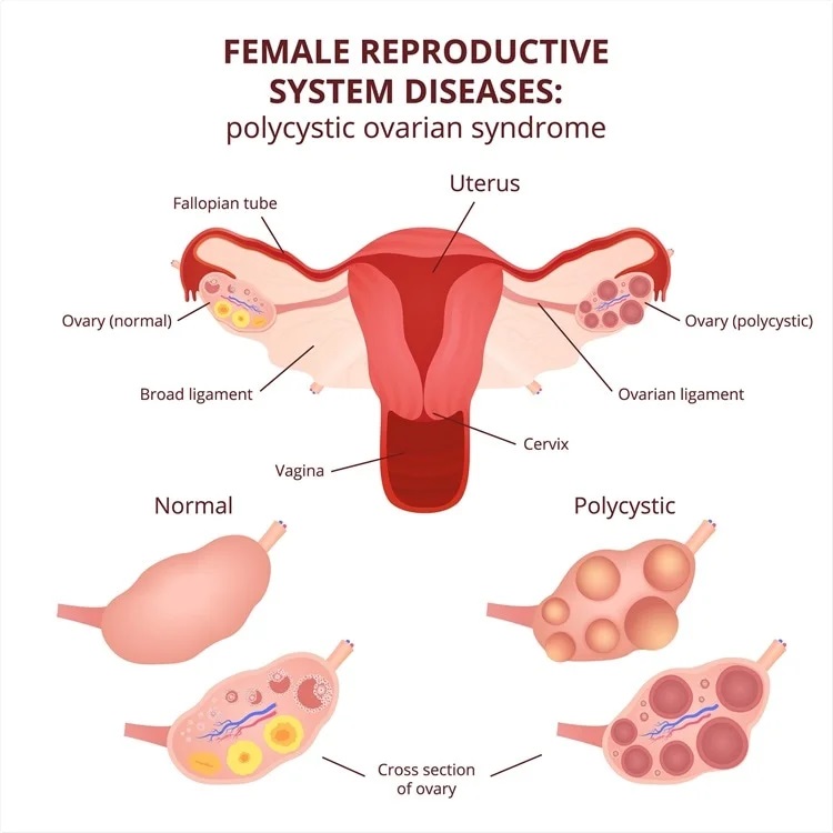 PCOD/PCOS