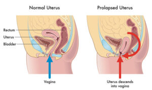 Uterine Prolapse