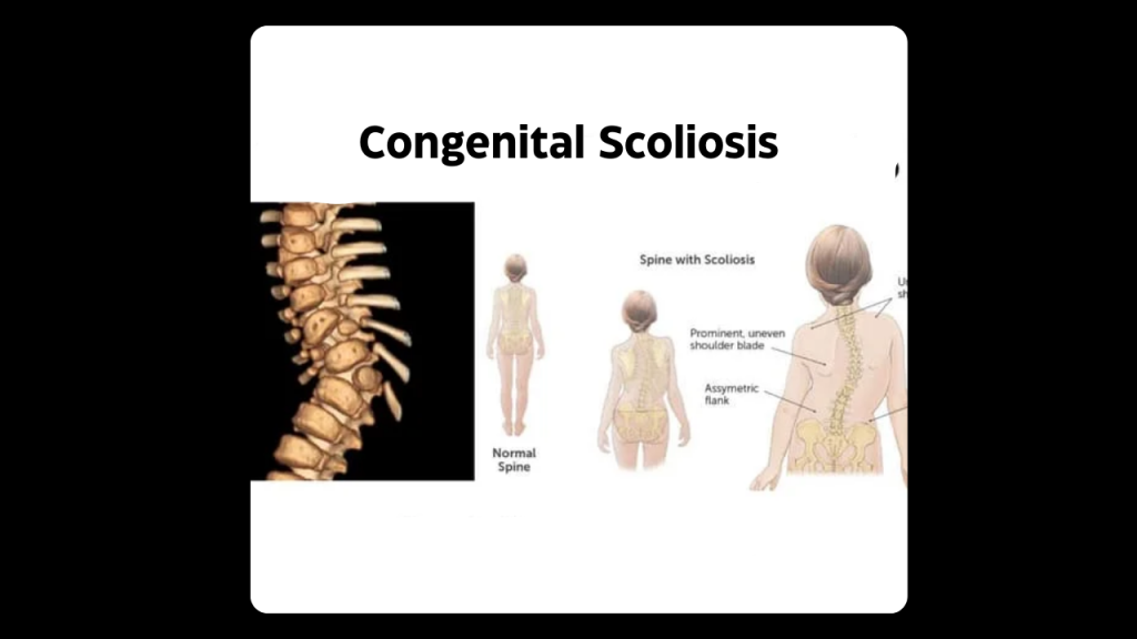 Iyengar Yoga Congenital Scoliosis