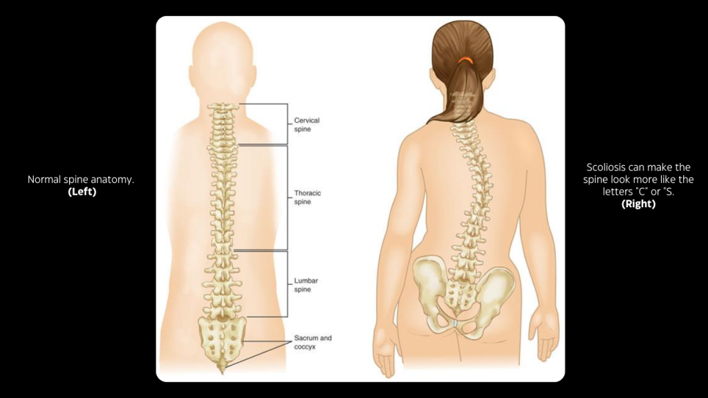 Iyengar Yoga Scoliosis